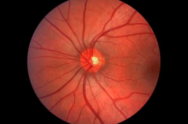 Glaucoma Selinsgrove, PA 
